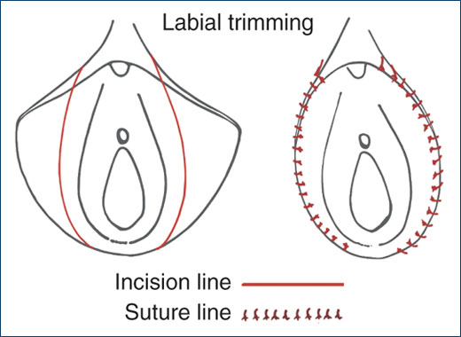 Cirug&iacute;a &iacute;ntima femenina
