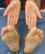 Identifican la causa gen�tica de la queratodermia palmoplantar difusa no epidermol�tica