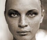 Tratamiento con l�ser de manchas en la piel