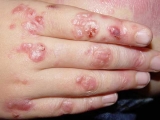 Epiderm�lisis bullosa (EB)