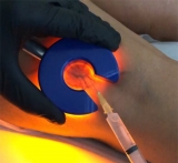 Escleroterapia por transiluminaci�n, ideal para eliminar venas varicosas